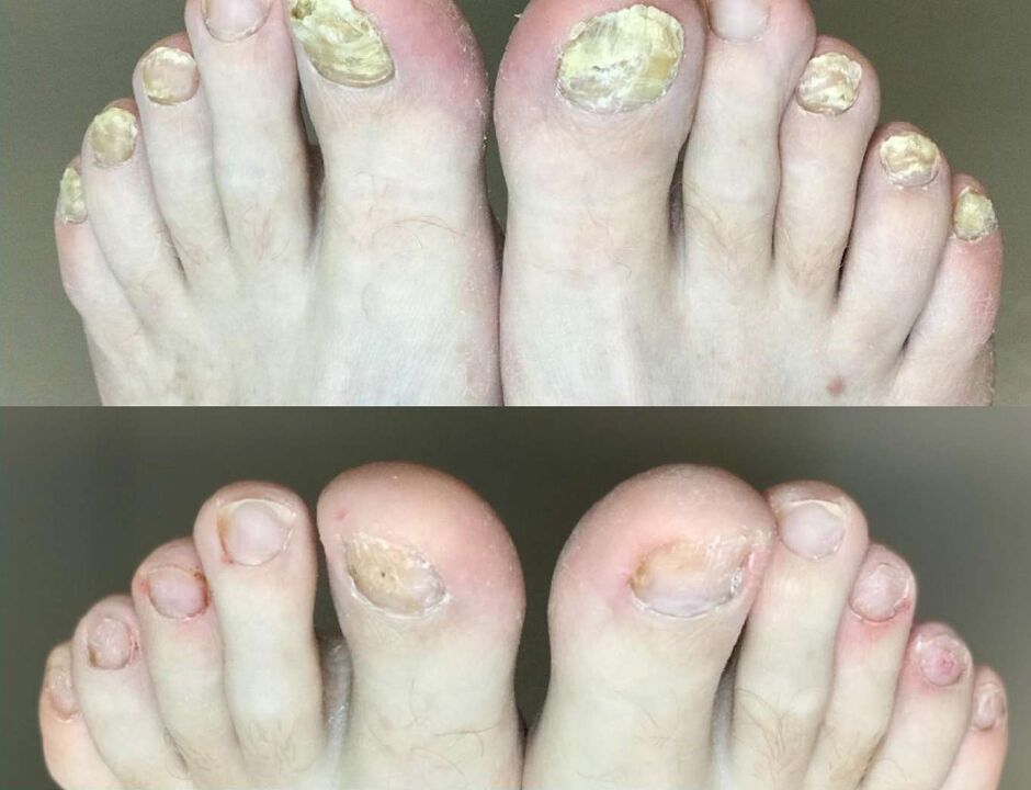 Antes e despois do tratamento a crema de promisil de cogomelos