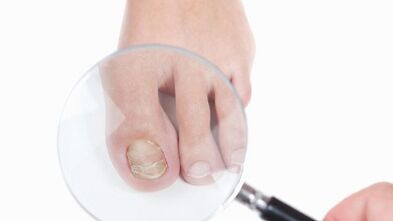 Como tratar un cogomelo no dedo pulgar da perna