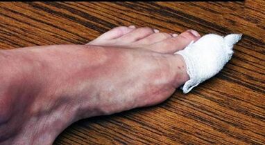 Comprime o tratamento do cogomelo no dedo pulgar da perna