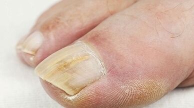 Os motivos da aparición do cogomelo no dedo pulgar da perna