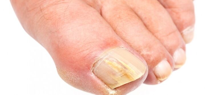 Unhas dos pés afectadas por fungos