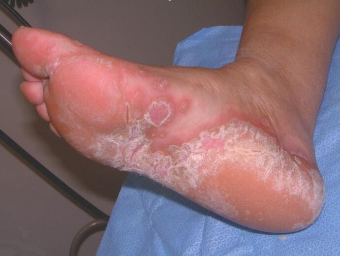 Pé afectado por unha infección fúngica