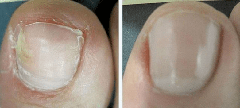Unhas antes e despois do tratamento con fungos